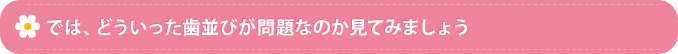 では、どういった歯並びが問題なのか見てみましょう